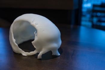 A 3D model of Cameron's skull, showing a substantial chunk completely missing, sits in his law office.