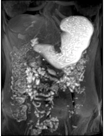 Image related to Gastroparesis - showing internal organs