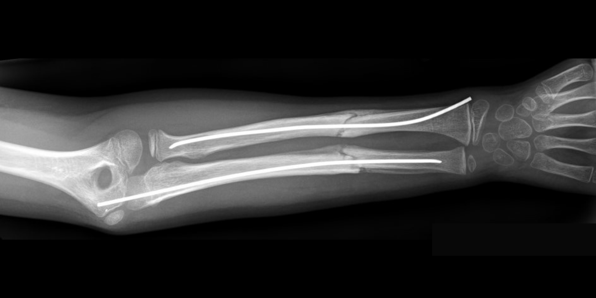 The x-ray of an arm repaired by an orthopaedic surgeon. A rod can be seen within the bone.